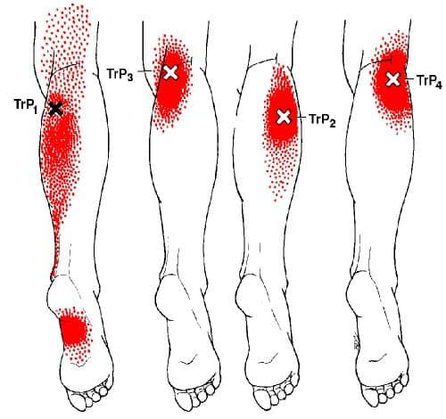 Trigger Points and Plantar Fasciitis - Body Heal Therapy